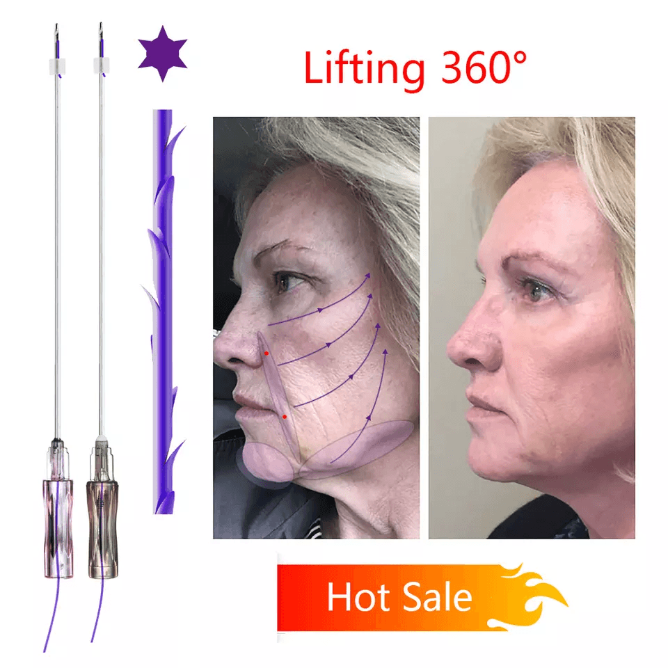 TRUGLYDE FAST 2.0 / 3.0 Suture thread