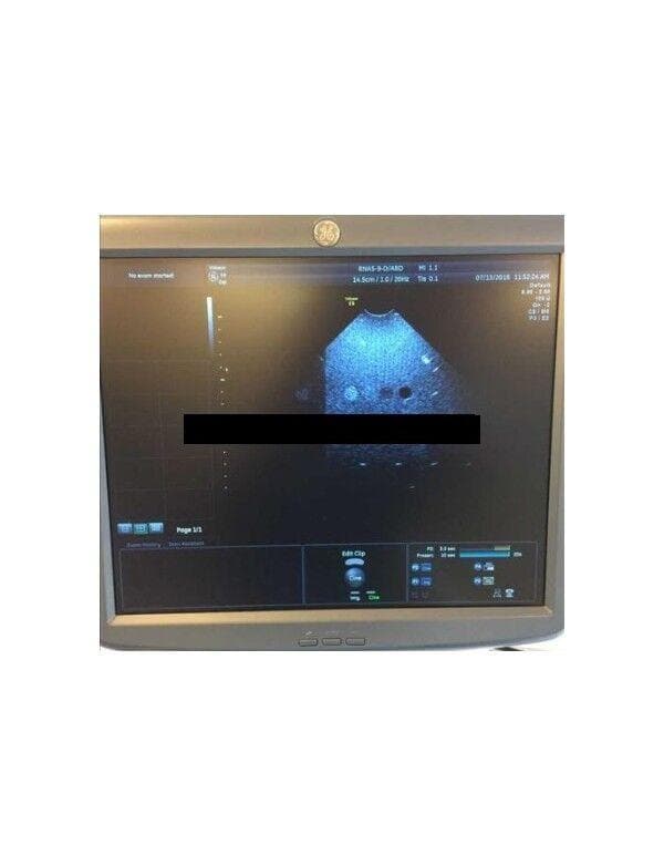GE RNA5-9-D Micro Convex Probe