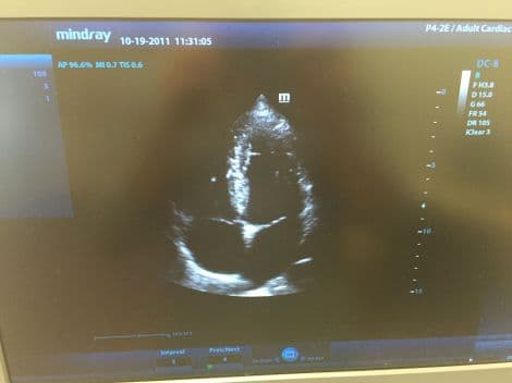 For Sale MINDRAY P4-2NE CARDIAC Ultrasound Transducer