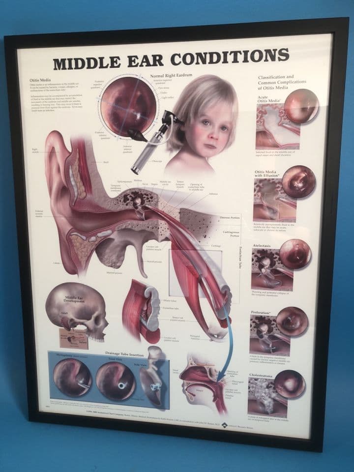 For Sale ANATOMICAL CHART CO. 9893 Middle Ear Conditions Poster